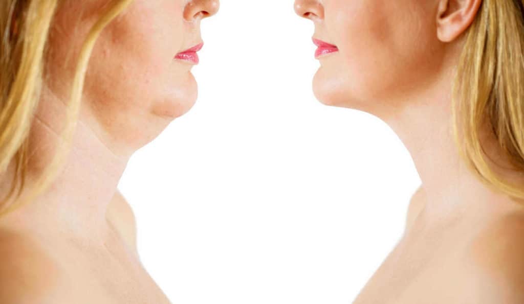 Double Chin treatment Leeds before and after results