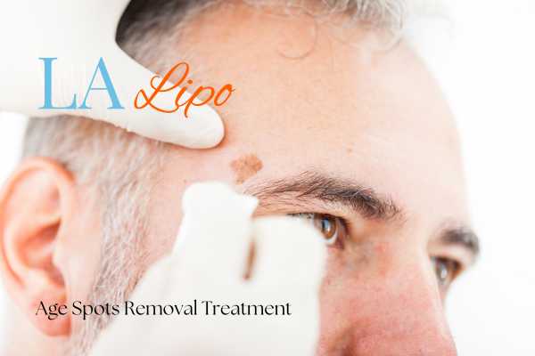 What Are the Most Effective Treatments for Age Spots Leeds?
