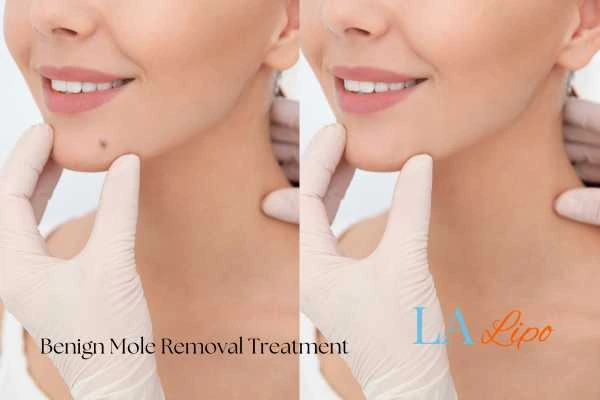 woman's before and after mole removal Leeds results