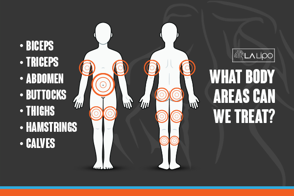 Graphic to show areas you can have LA-EMS Body Sculpting Leeds treatment.