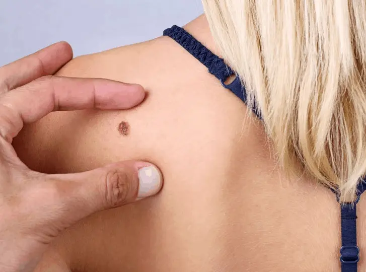 woman having mole removal Leeds consultation before treatment.