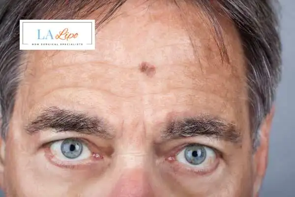 Solar Lentigo Removal Leeds image of man with mark on his forehead