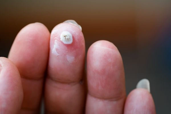 wart on person finger - cryotherapy to treat from LA LIPO Leeds