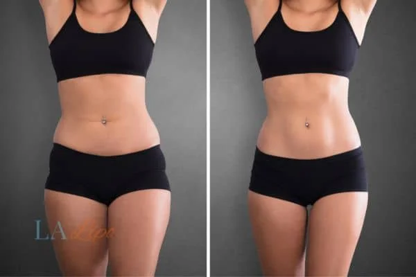 before and after results of non-surgical treatment to help a woman's body image and mental health Leeds