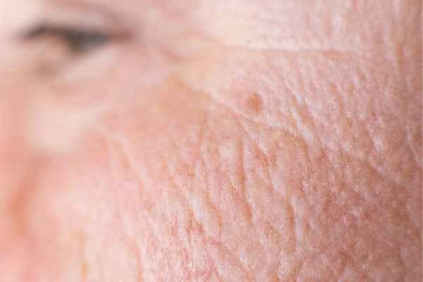 close up picture of a woman's face showing an age spot Leeds