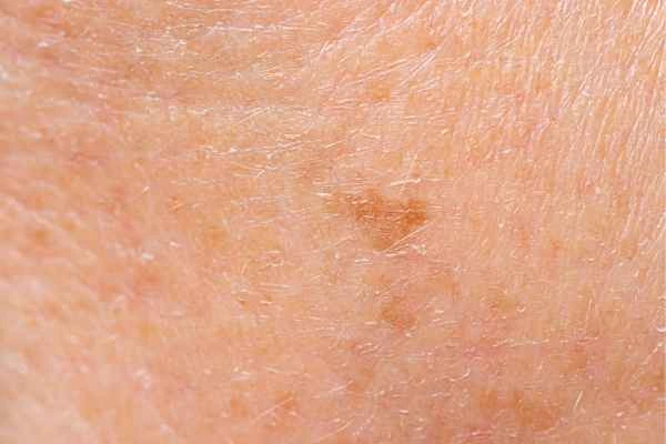 close up picture of age spots Leeds