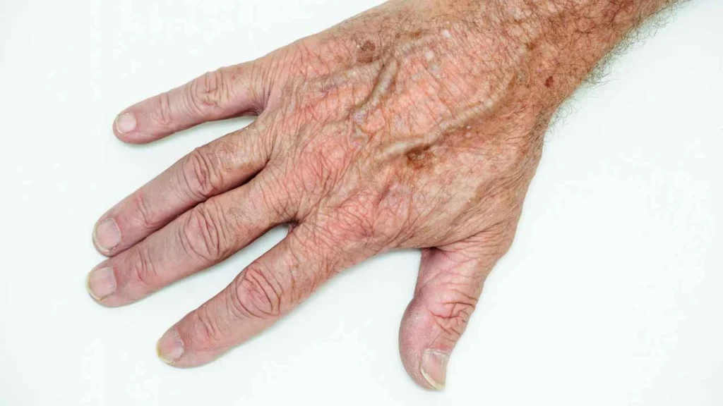 Male hand showing age spot Leeds