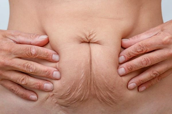 Image of a woman's stomach with loose skin - example of skin tightening Leeds options
