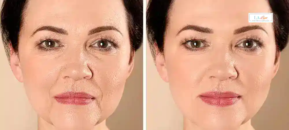 How Long Does It Take to See Results and How Long Do They Last Leeds?